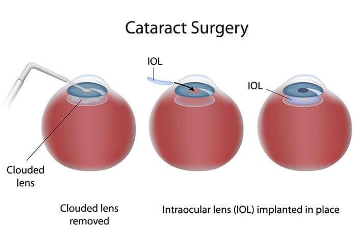 Steps of Cataract Surgery, Implanting The IOL Lens