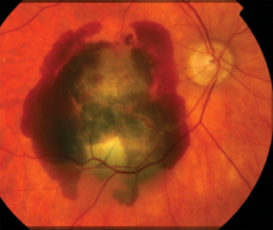 CNVM with subretinal hemorrhage 