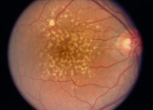 Patient with dry intermediate drusen 