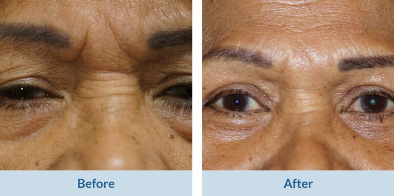 blepharoplasty before and after