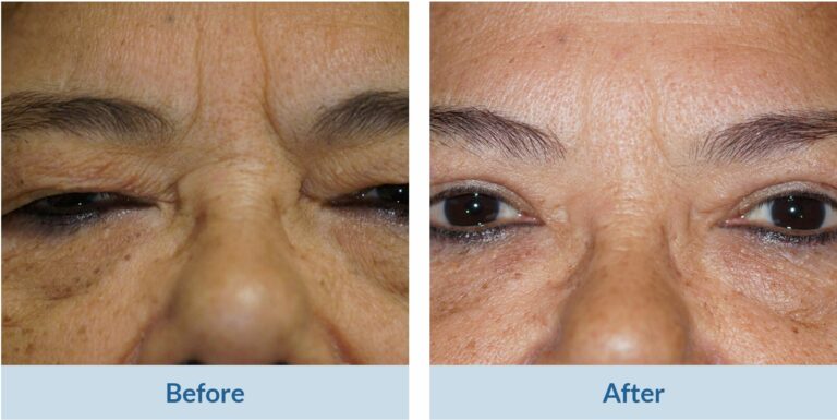 blepharoplasty before and after