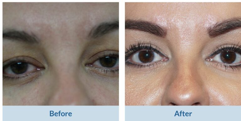 blepharoplasty before and after