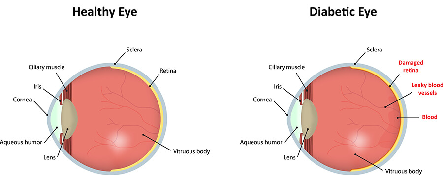 Chart Illustrating a Healthy Eye vs a Diabetic Eye