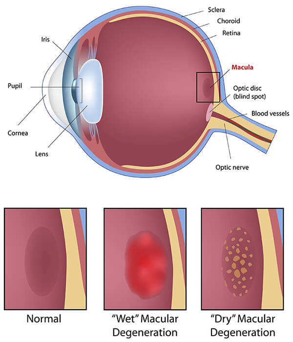 Chart About Macular Degeneration