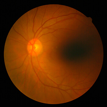 Retinal Scan
